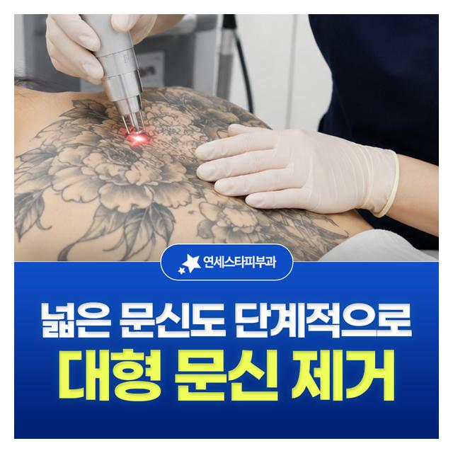 대형 문신 제거, 넓은 문신도 단계적으로 제거하는 연세스타피부과